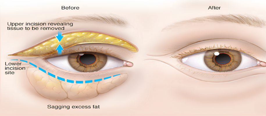 Under-the-eye-bags-surgery-turkey.png (537 KB)