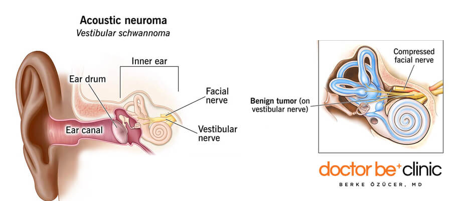 Acoustic Neuroma