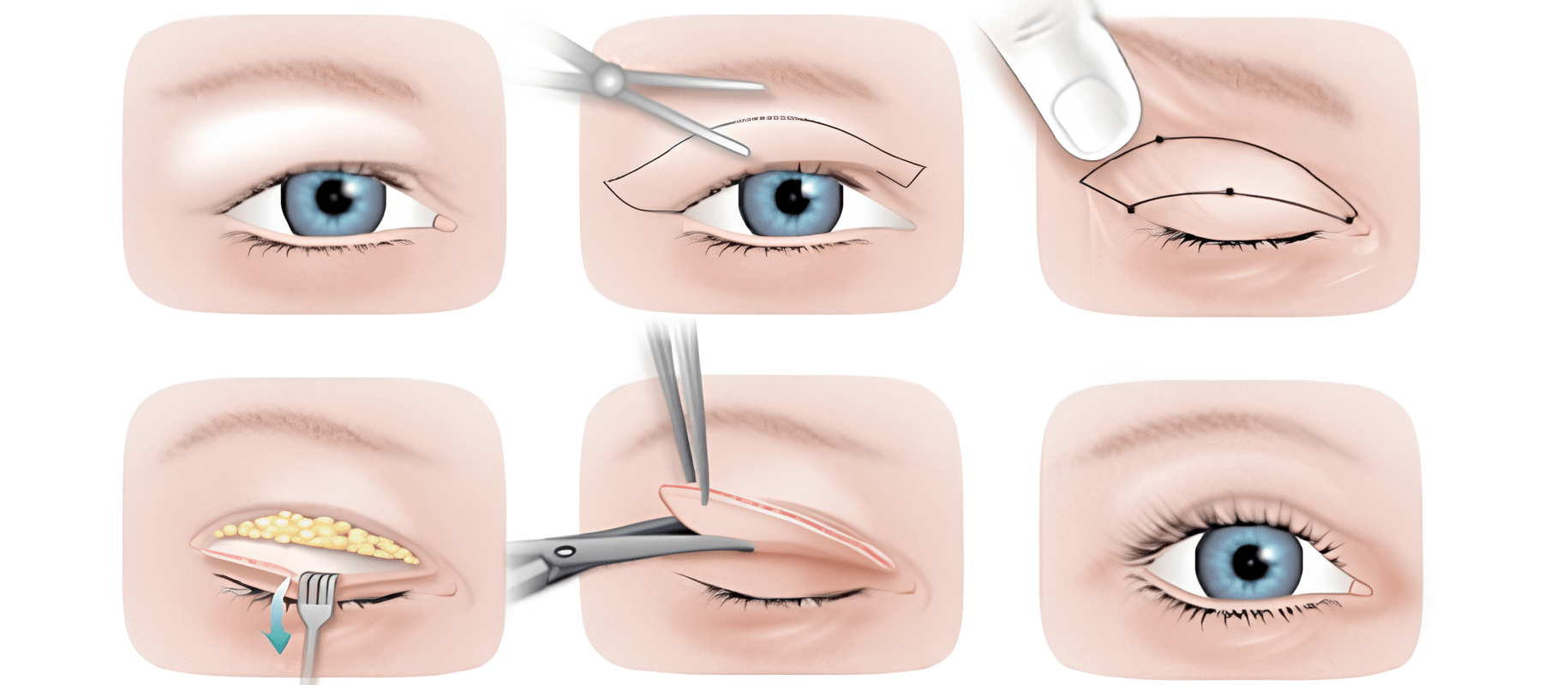 eyelid-aesthetics-turkey.png (395 KB)