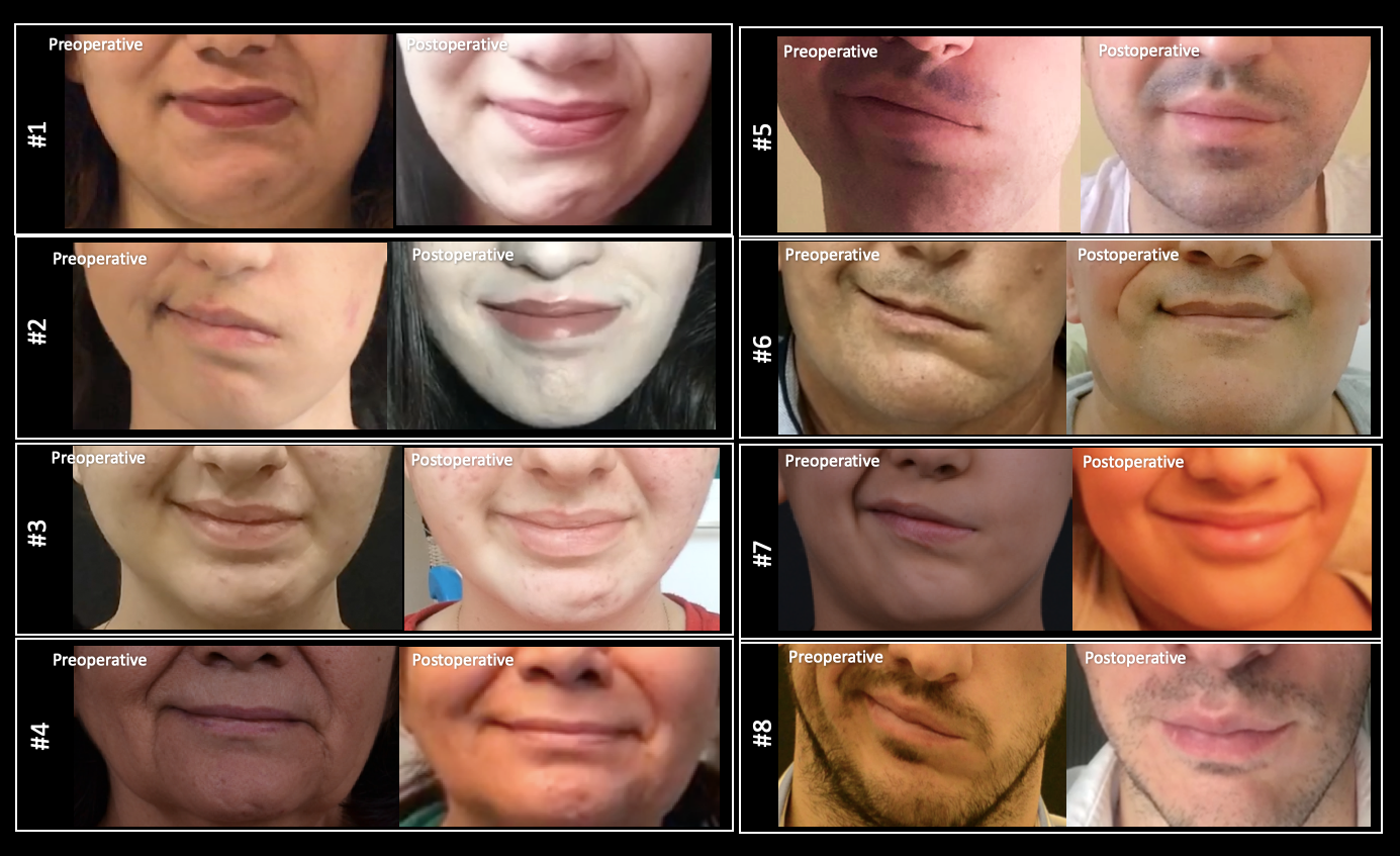 facial-reanimation-before-afters-microsurgery-nervetransfer-facialparalysis.jpeg (1.42 MB)