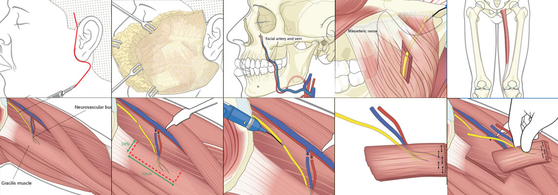 How is Facial Reanimation Performed Using Gracilis Free Flap Surgery?