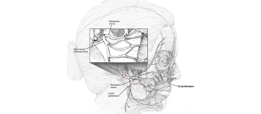 Masseter Facial Nerve Transfer