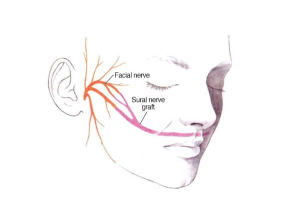 Gracilis Free Flap Surgery
